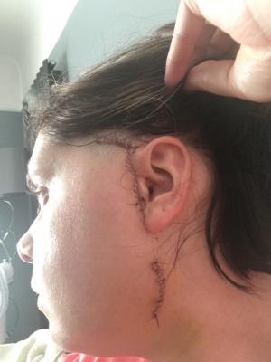 O femeie, desfigurată după ce şi-a dislocat mandibula încercând să mănânce un burger de la KFC, în Marea Britanie
