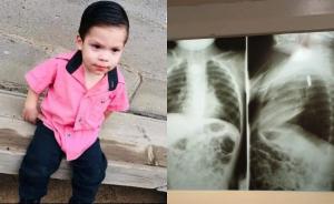 Copil de 2 ani, în stare critică după ce a înghiţit o baterie. Medicii din Mexic s-au luptat două săptămâni să îl salveze