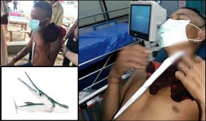 Turist ghinionist, în stare gravă la spital, după ce un peşte zargan l-a înţepat în gât, în timp ce înota, în Thailanda