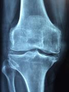 Un nou test de sânge poate detecta osteoartrita cu până la opt ani înainte ca boala să se vadă la radiografie